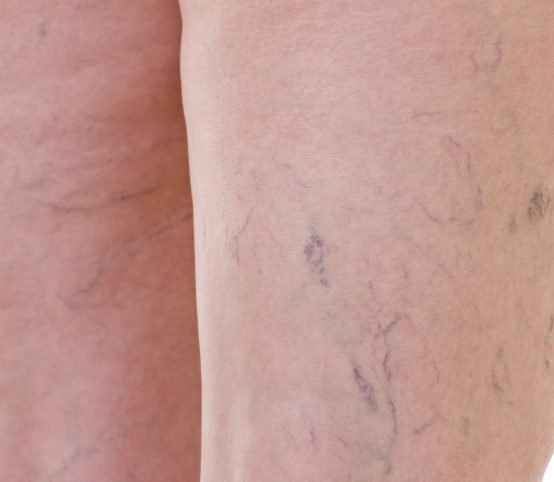 Sclerotherapy Sclerotherapy