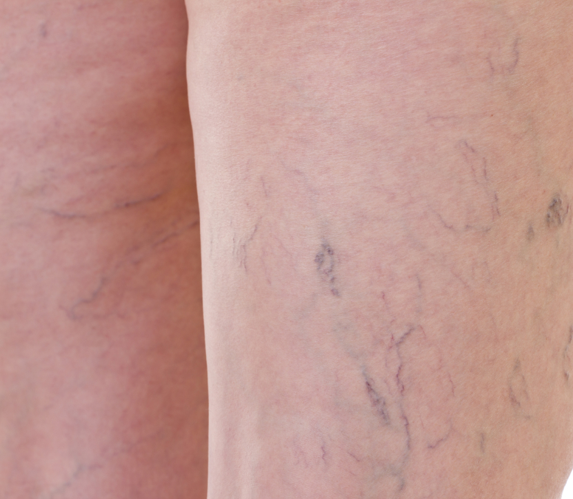 Sclerotherapy