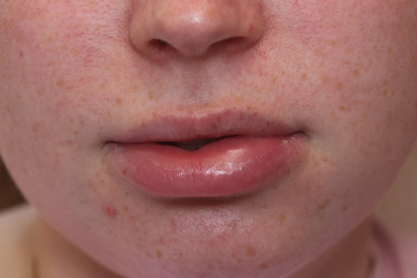 Dermal Filler Migration