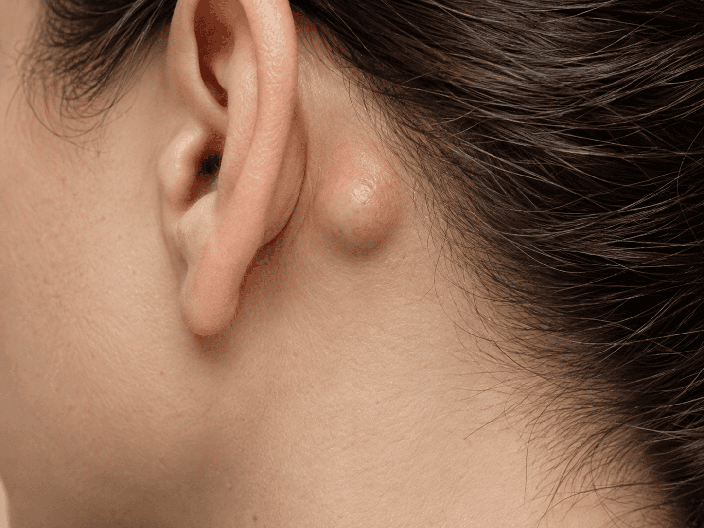 Epidermoid Cysts