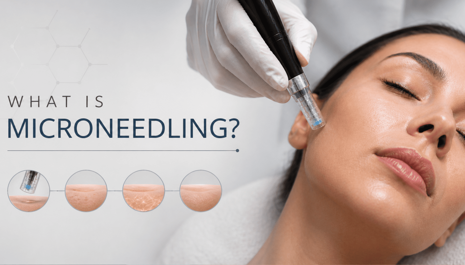 What Is Microneedling? Benefits, Results & Does It Really Work?