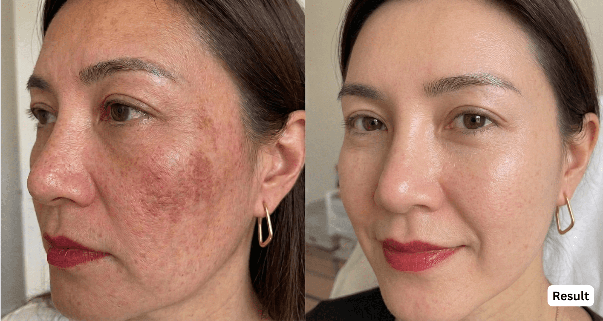 Skin Boosters Before and After