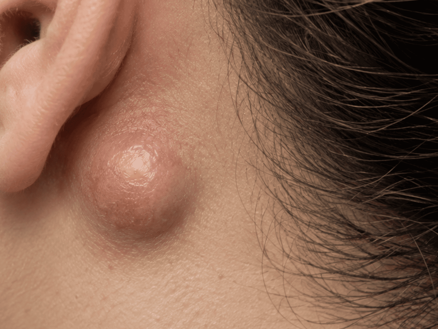 Sebaceous Cysts
