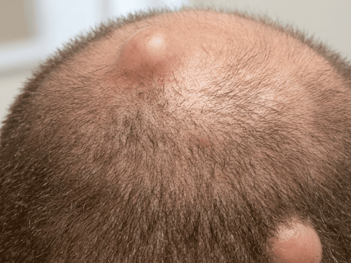 Scalp Cysts