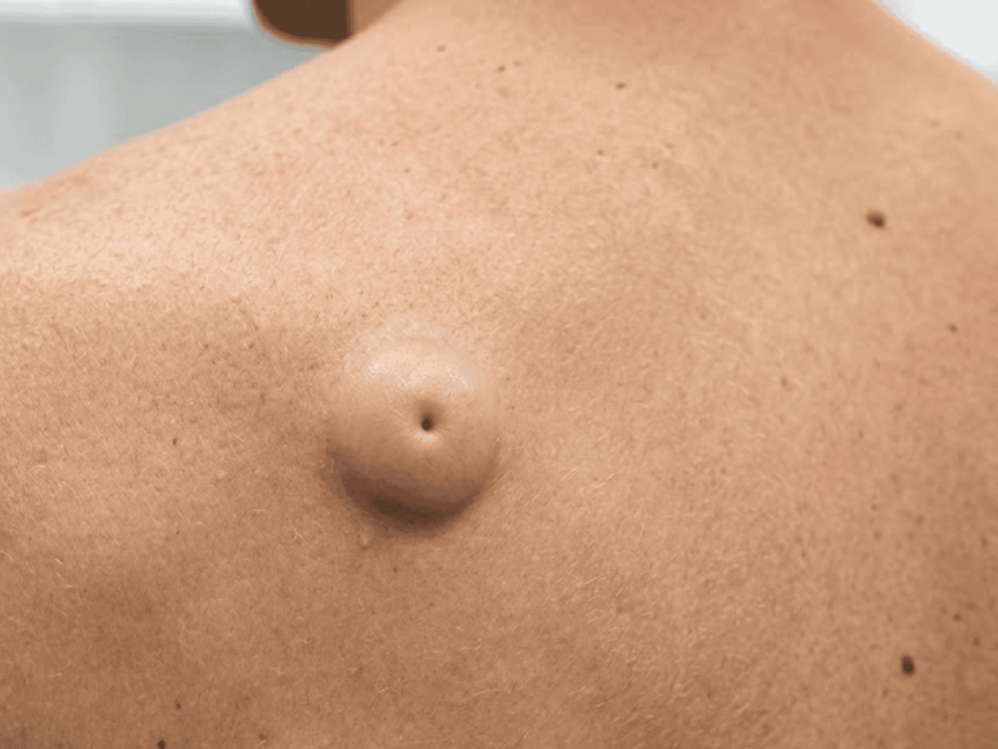 Body cyst