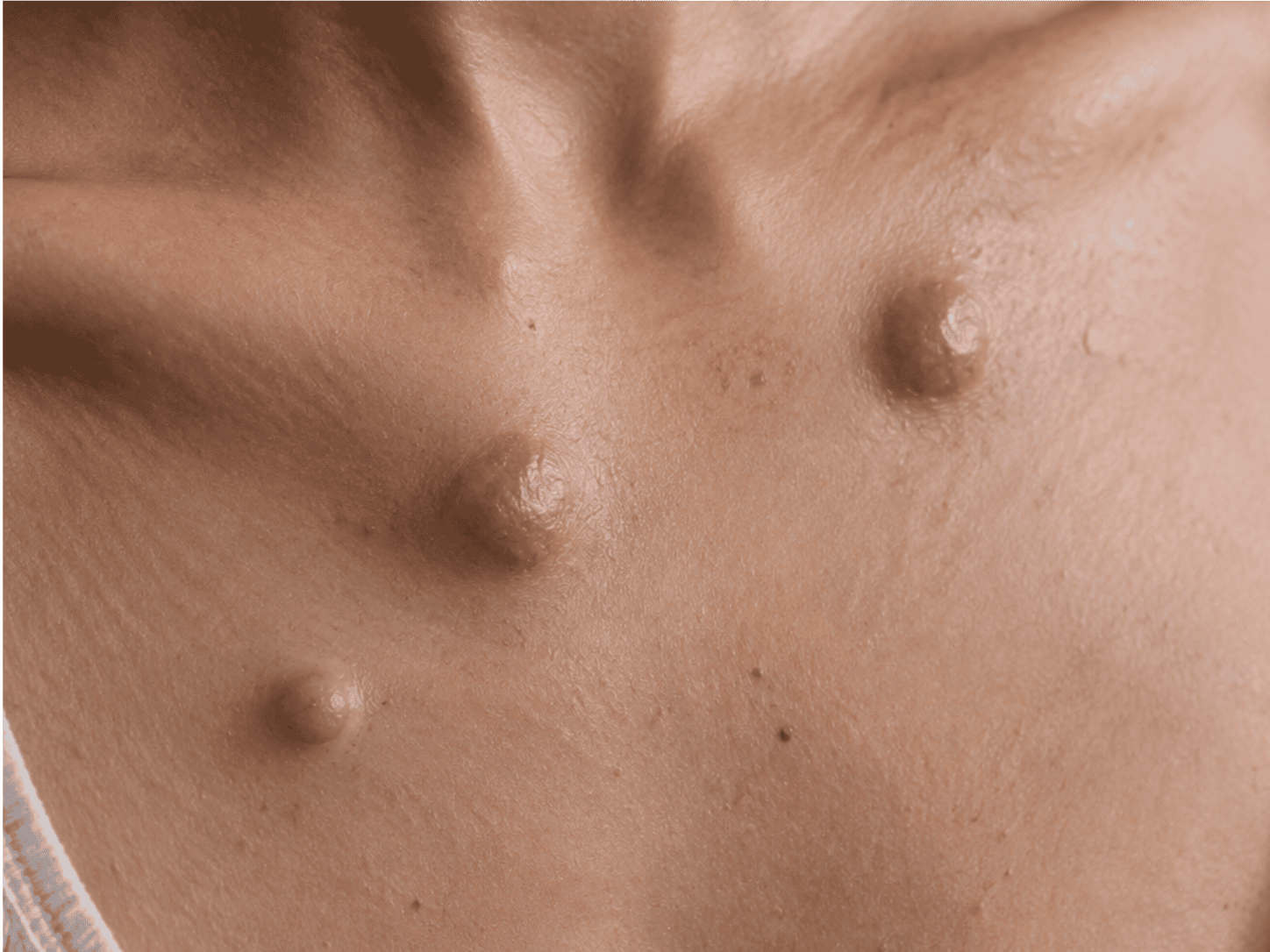 Multiple Cysts