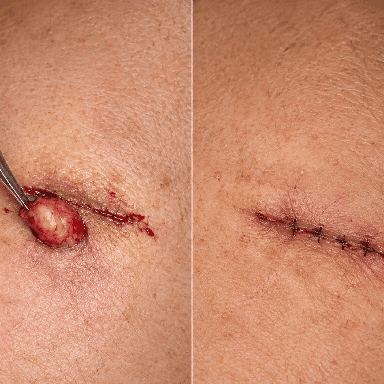 Cyst Removal Recovery & Aftercare