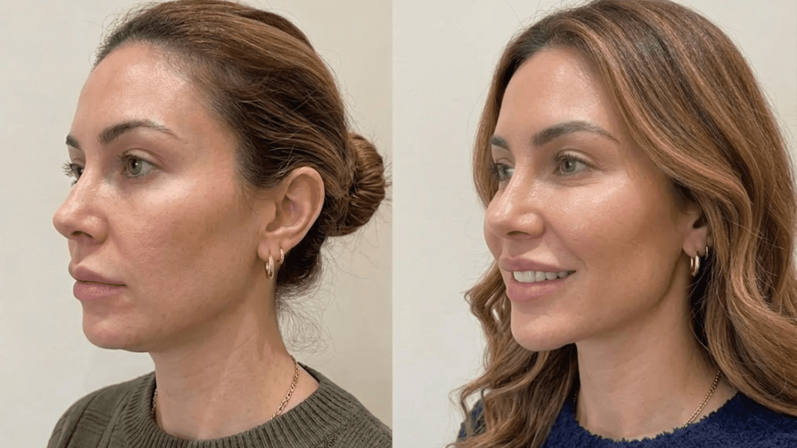 injectable fillers for the jawline