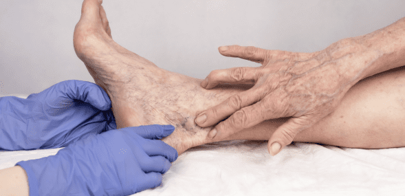 Spider Vein Removal