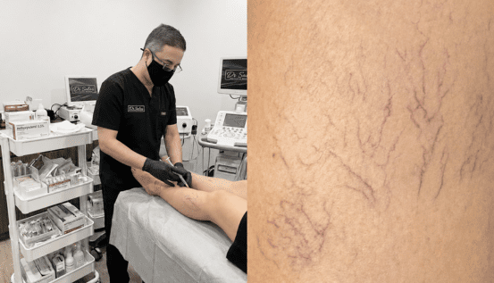Spider Vein Removal