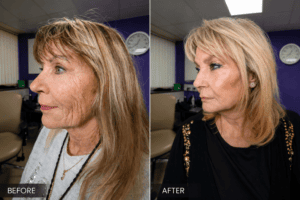 skin booster before after