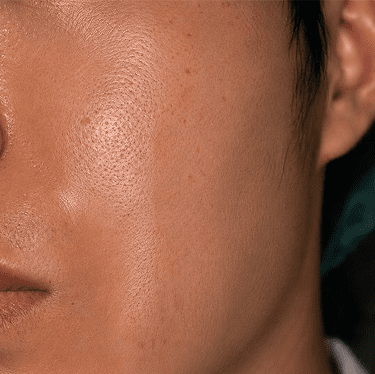 face treatemenrt after