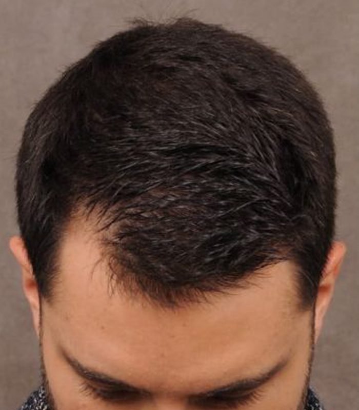 Before Hair