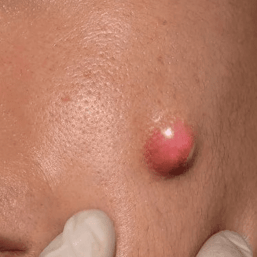 face treatemenrt before