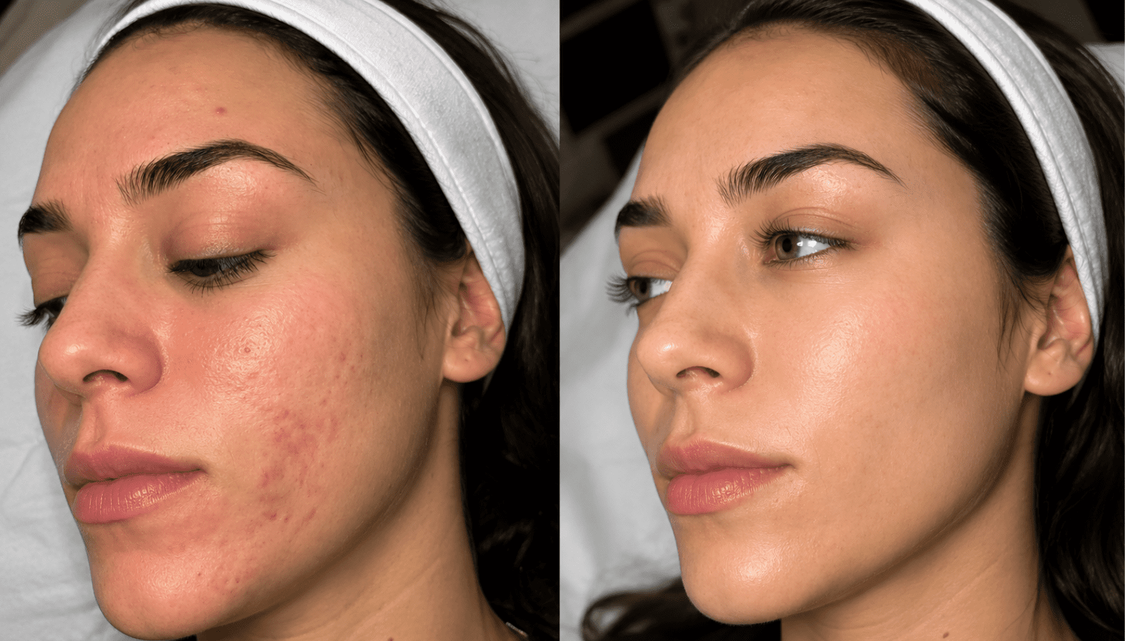 Microneedling Before and After