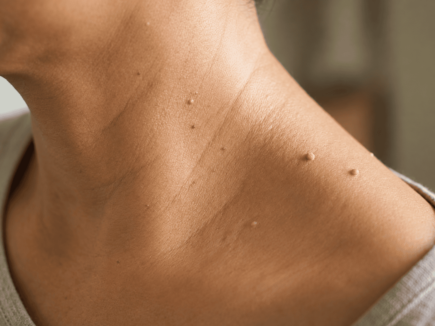 skin tag removal